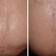 Illustration for article titled Selecting the Right Scar Removal Product
